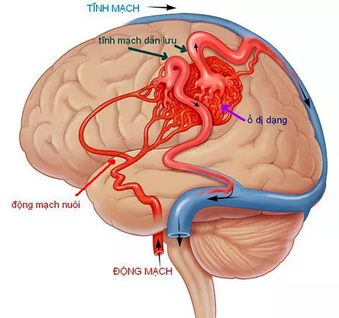 CẢNH GIÁC: Bệnh dị dạng mạch máu não nguy hiểm như thế nào?