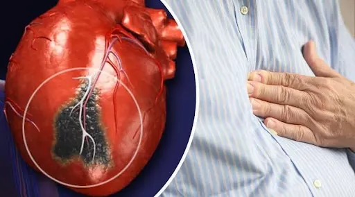 Thiếu máu tim cục bộ và tất cả những điều bạn cần biết