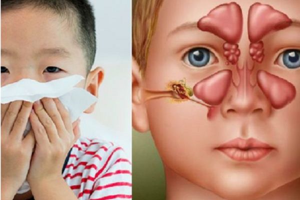 Trẻ em bị viêm mũi do nhiều nguyên nhân gây ra
