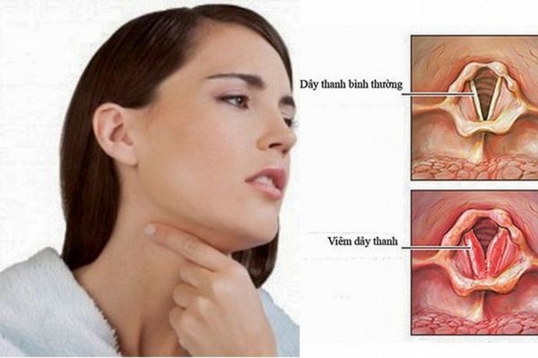 Viêm dây thanh quản khiến người bệnh khàn giọng, đau họng, khó chịu