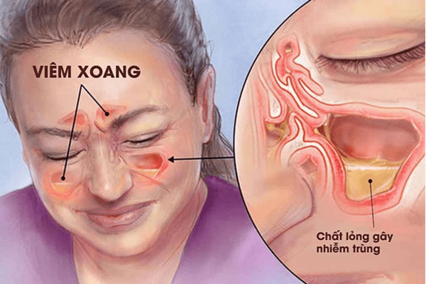 Viêm xoang là một trong những nguyên nhân dịch mũi chảy xuống họng