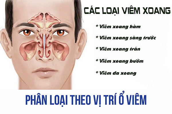 Tìm hiểu về viêm xoang và cách điều trị bệnh hiệu quả - Xem ngay!