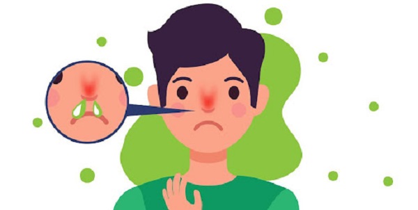 Viêm xoang mạn tính gây chảy dịch mũi