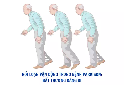 Dang-di-cham-chap-la-roi-loan-van-dong-thuong-thay-o-benh-Parkinson