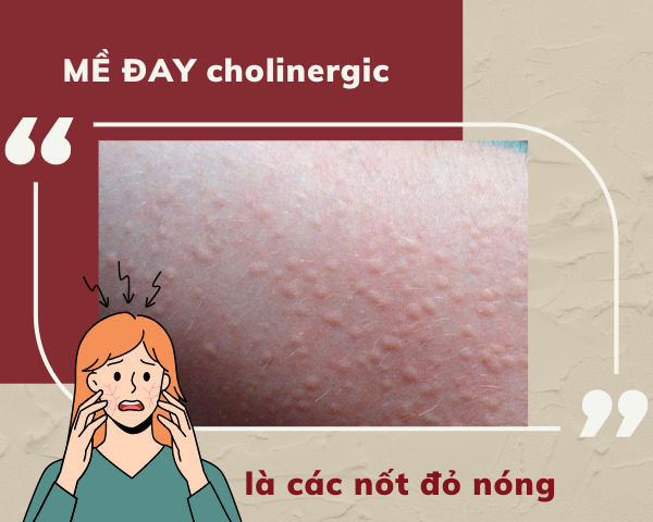 Mề đay cholinergic có biểu hiện là các nốt đỏ nóng, ngứa