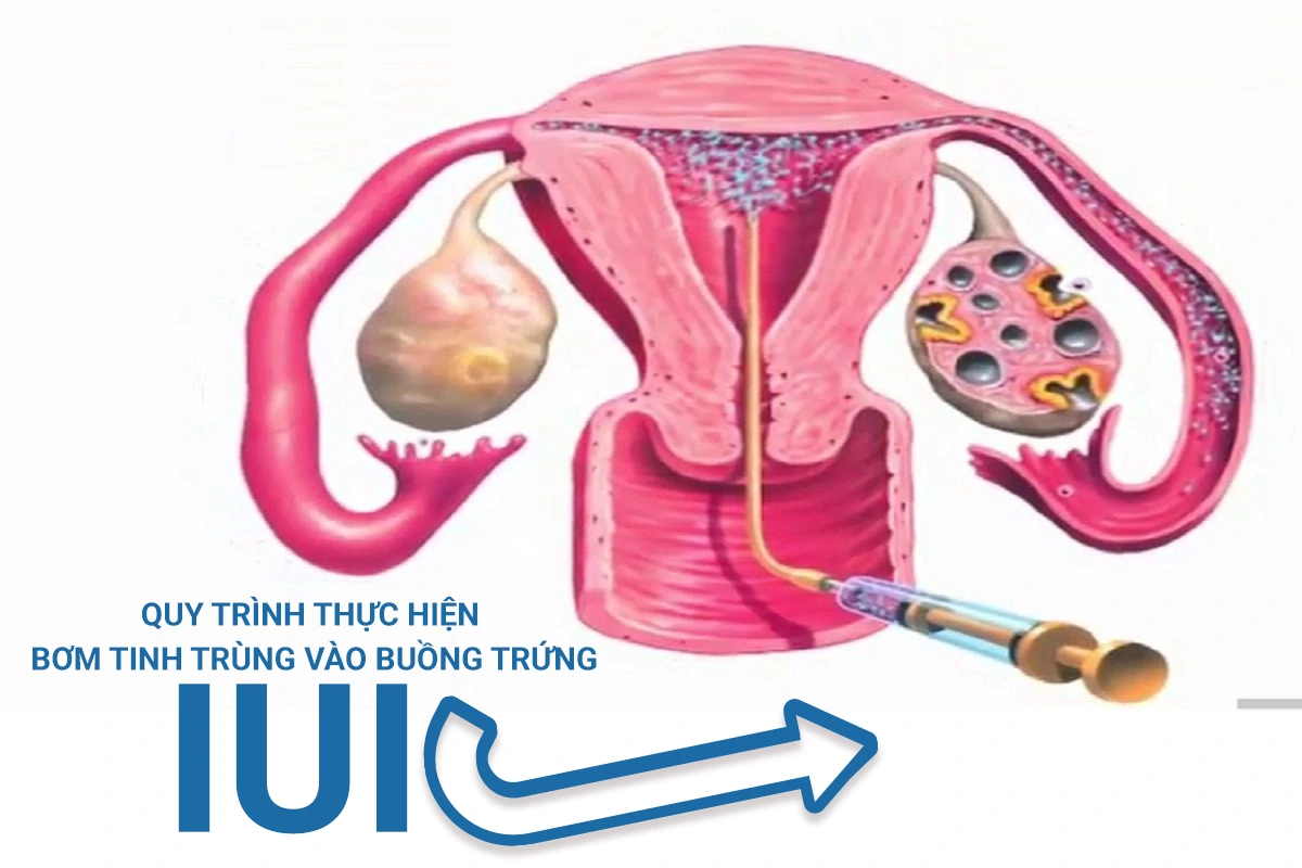 IUI và quy trình thực hiện bơm tinh trùng vào buồng tử cung