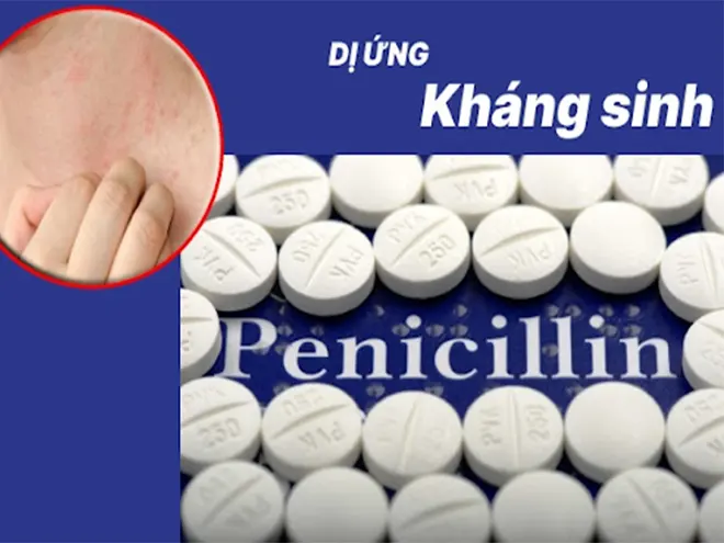 penicillin-la-thuoc-khang-sinh-thuong-gay-di-ung-nhieu-nhat.webp