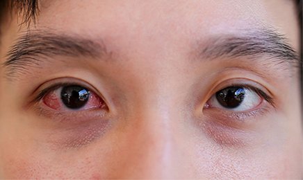Đau mắt đỏ là bệnh dễ tái phát và lây lan nhanh chóng