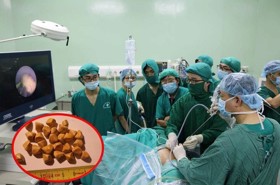 [Giải đáp] Cắt túi mật sống được bao lâu - Có cách nào không cần cắt túi mật