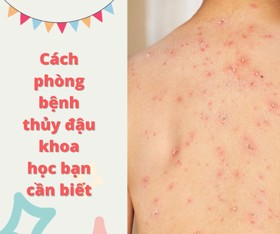 Cách phòng bệnh thủy đậu khoa học bạn cần biết