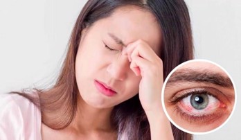 Bị đau mắt đỏ bao lâu thì khỏi? Điều trị như thế nào?