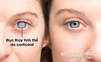 Đục thủy tinh thể do corticoid – Nhận biết sớm để tránh mù lòa!