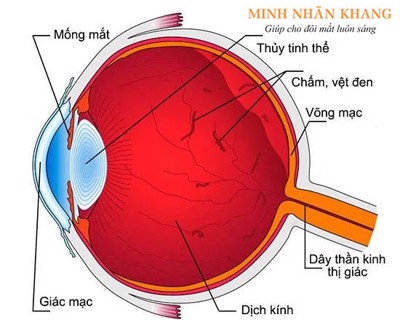 Cách chữa ruồi bay vẩn đục dịch kính, loại bỏ chấm đen hiệu quả