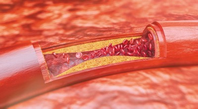 Những điều cần biết về bệnh xơ vữa động mạch cảnh