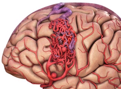 Dị dạng động, tĩnh mạch não có thể dẫn đến đột quỵ