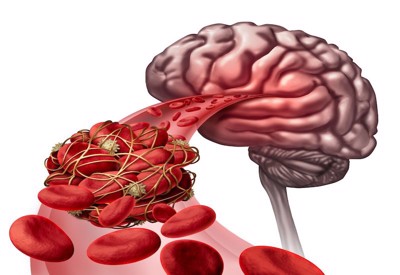 Hiểu về tắc mạch máu não để ngăn ngừa cơn đột quỵ