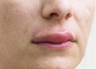 Dị ứng sưng môi – Nguyên nhân và cách khắc phục triệt để