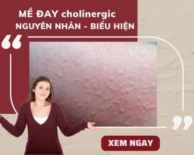 Mề đay cholinergic: Nguyên nhân, biểu hiện và cách điều trị