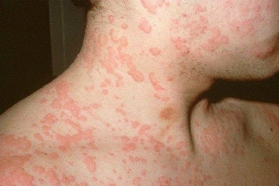 Phải làm gì khi nổi mề đay? Tất cả những điều cần biết về mề đay