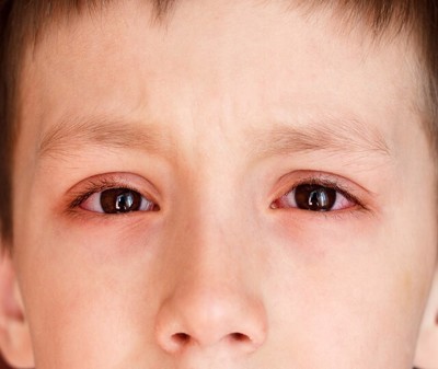 Người bị đau mắt đỏ nên kiêng gì để bệnh nhanh khỏi?