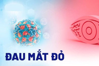 Hướng dẫn nhận biết triệu chứng đau mắt đỏ dễ dàng
