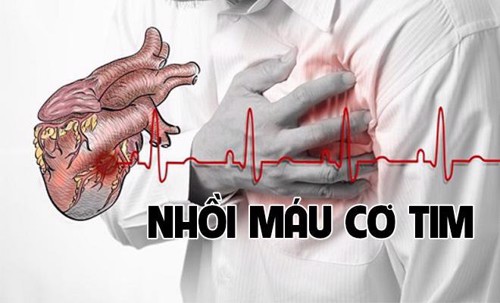 Cách sơ cứu nhồi máu cơ tim nhanh chóng bạn nên ghi nhớ