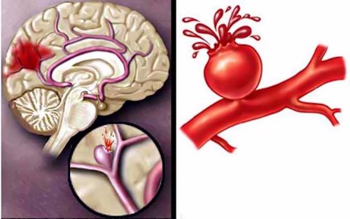 Xuất huyết não có nguy hiểm không? Câu trả lời sẽ có tại đây