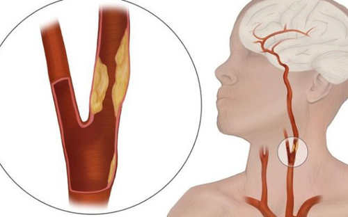 Hẹp động mạch cảnh và tai biến mạch máu não