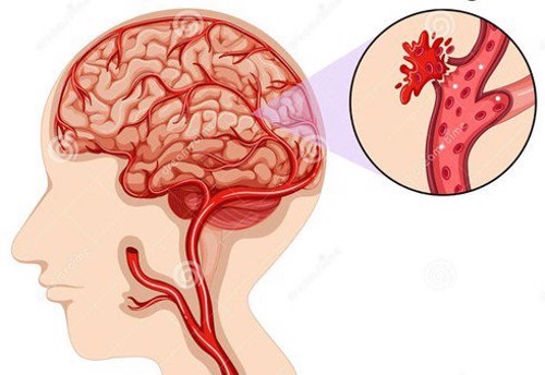 Điều trị đột quỵ xuất huyết não bằng phương pháp phẫu thuật ít xâm lấn 